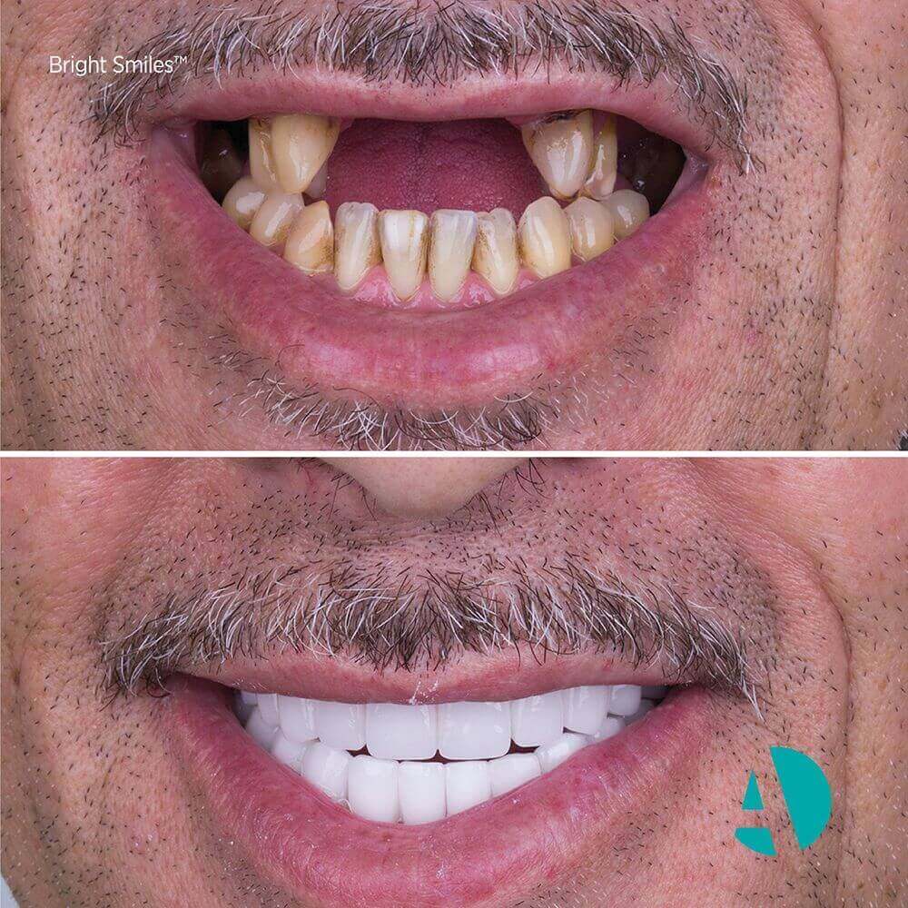 Dental-implant-Turkey-7