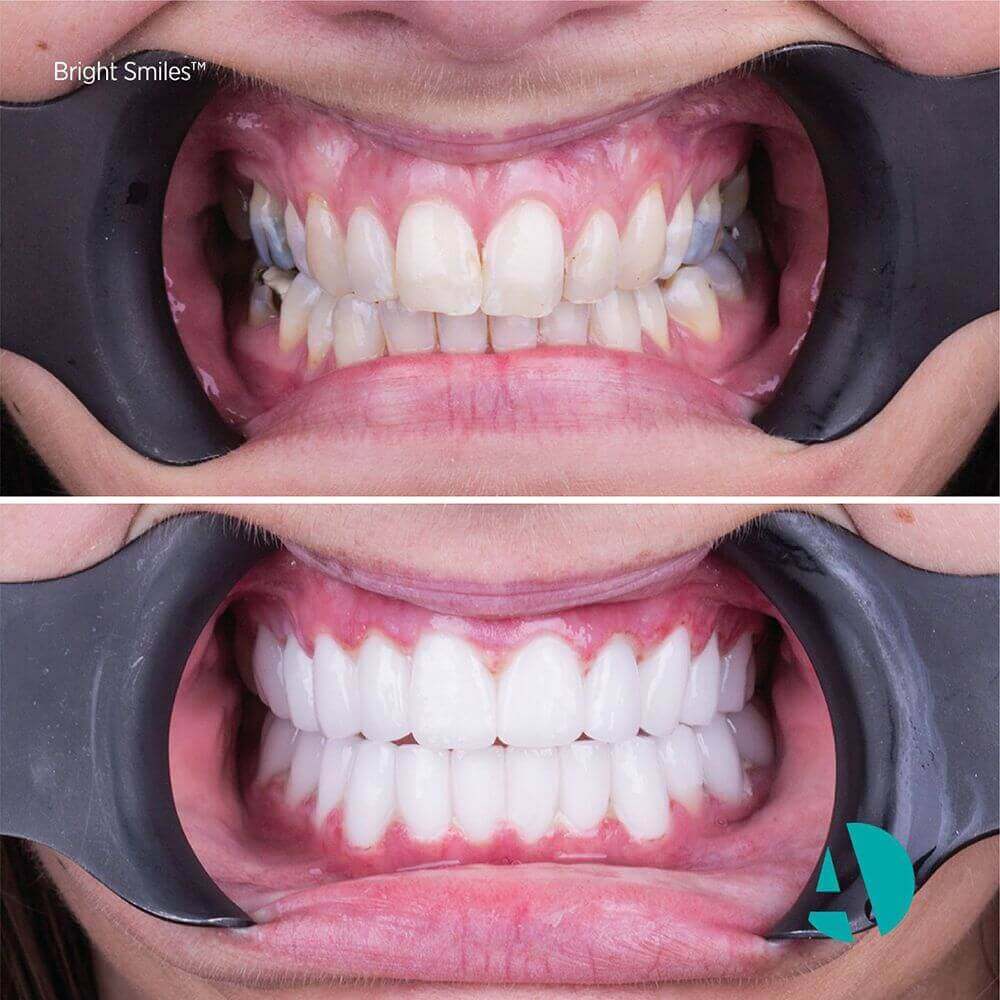 Dental-implant-Turkey-9