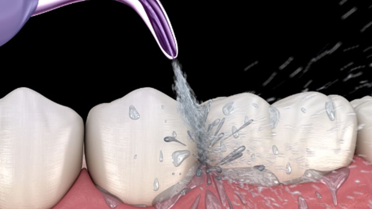 What is airflow teeth cleaning?