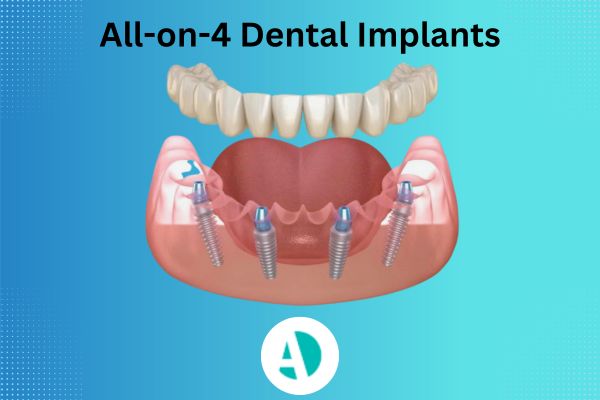 All-on-4 dental implants Antalya
