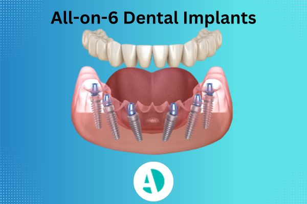 All-on-6 dental implants Antalya