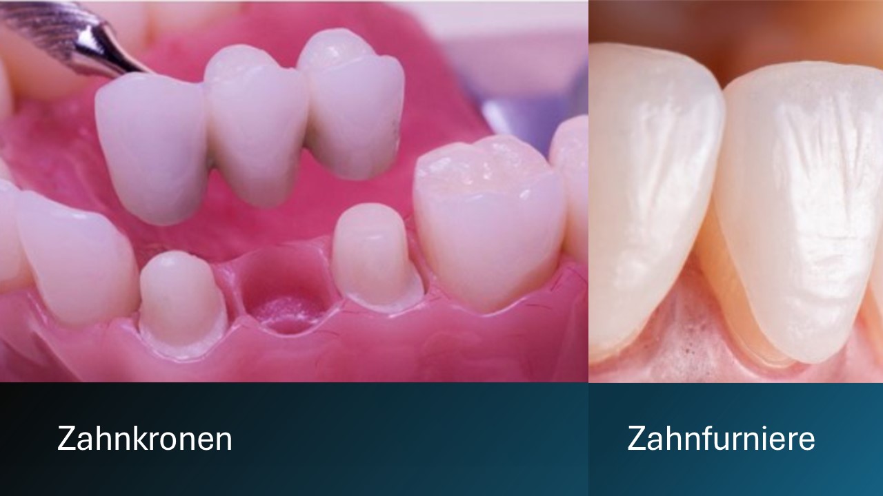 Was sind Zahnkronen und Zahnveneers?