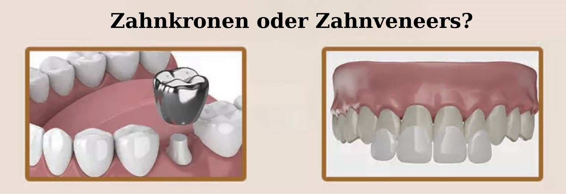 Zahnkronen vs. Zahnveneers: Was ist das Richtige für Sie?