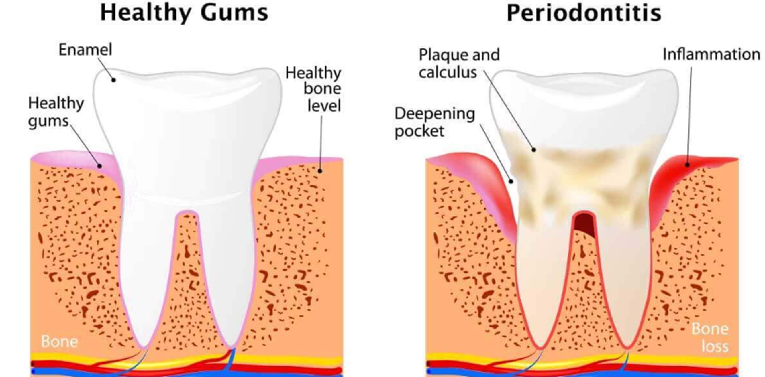 What is a Tooth Abscess?