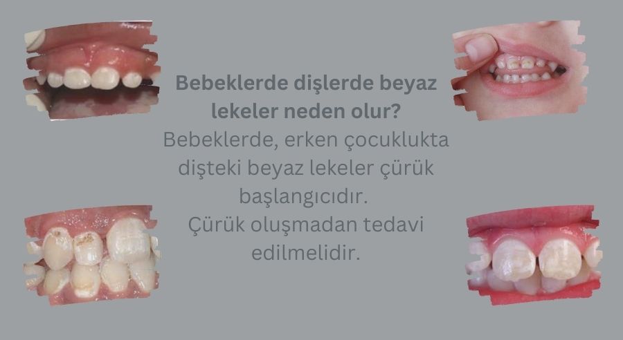 Bebeklerde dişlerde beyaz lekeler neden olur?  Antalya