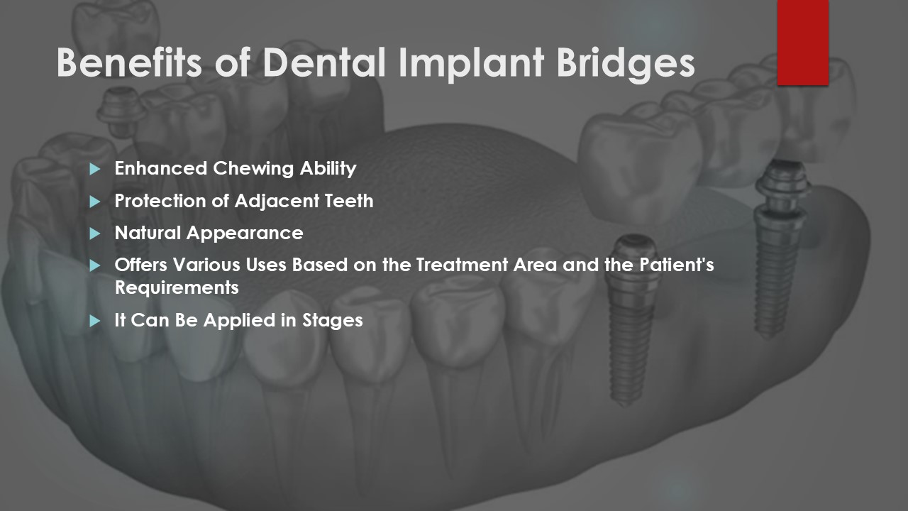 How do implant-supported bridges work?