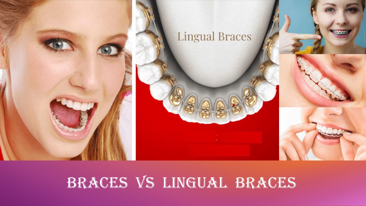 Braces vs lingual braces