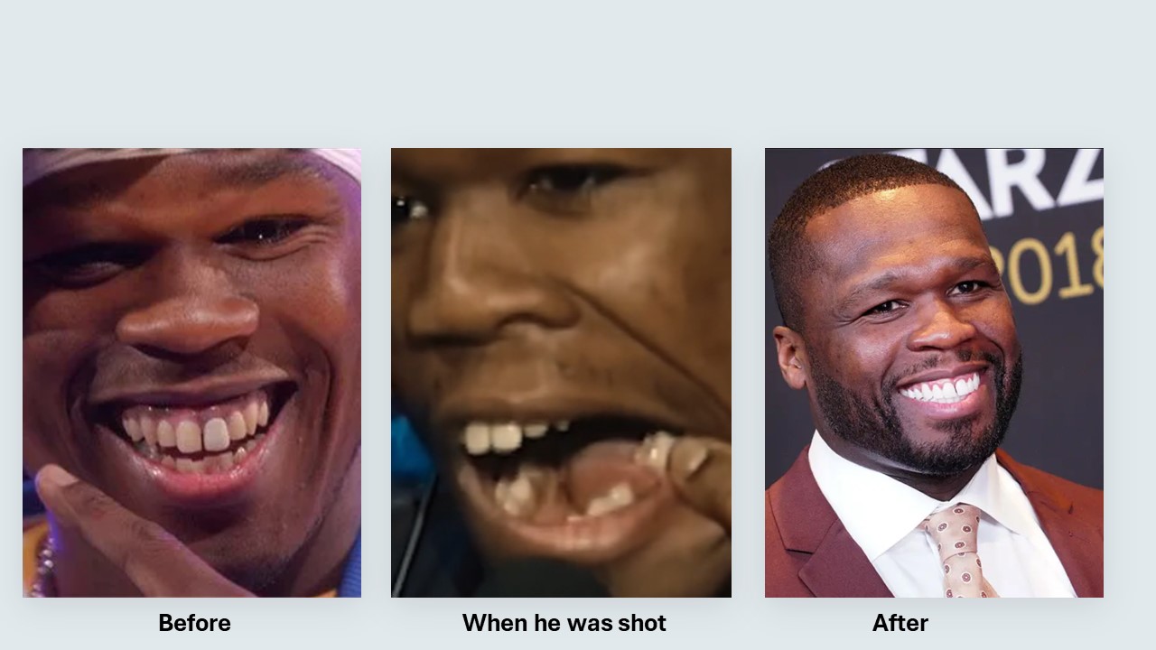 celebrities with teeth implants before and after 50 Cent