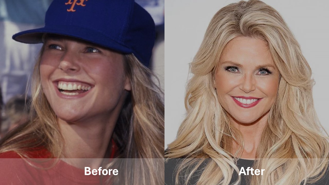 celebrities with teeth implants before and after Chiristian Berkley