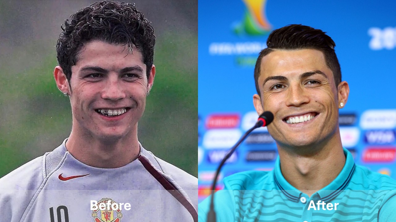 celebrities with teeth implants before and after Cristiano Ronaldo