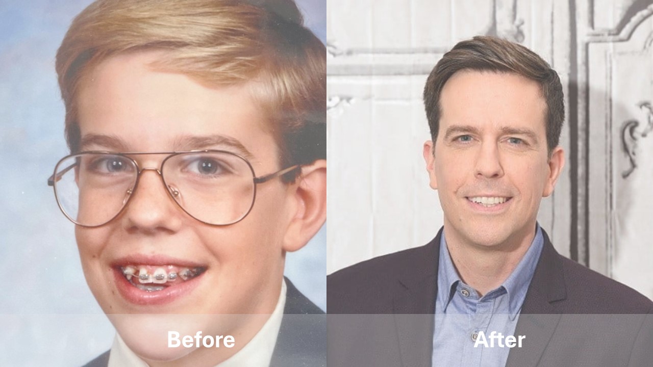 celebrities with teeth implants before and after Ed Helms