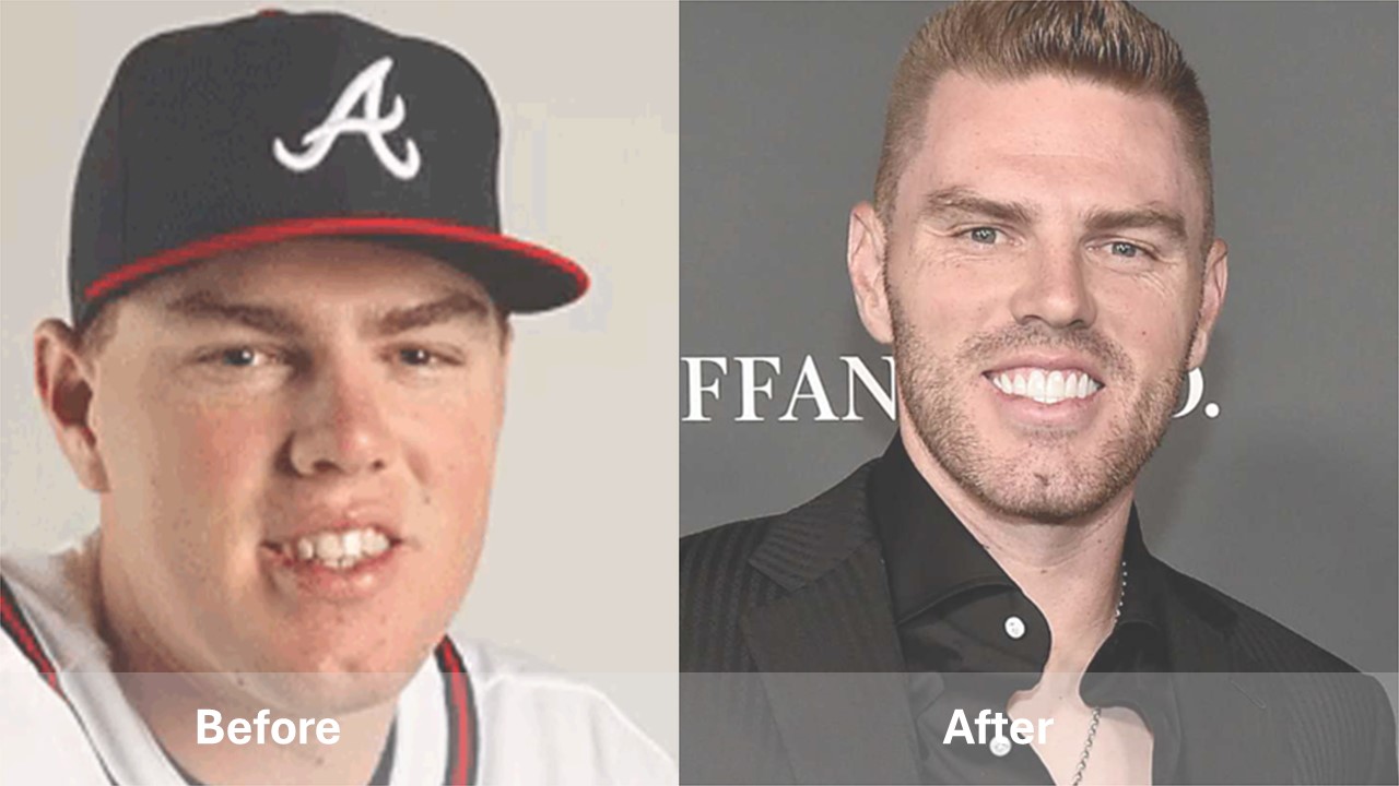 celebrities with teeth implants before and after Freddie Freeman