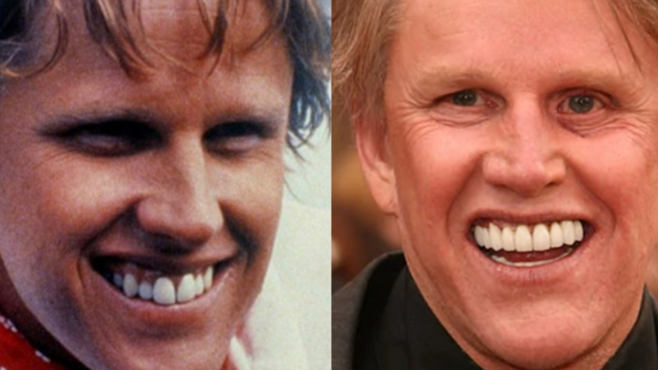 celebrities with teeth implants before and after Gary Busey