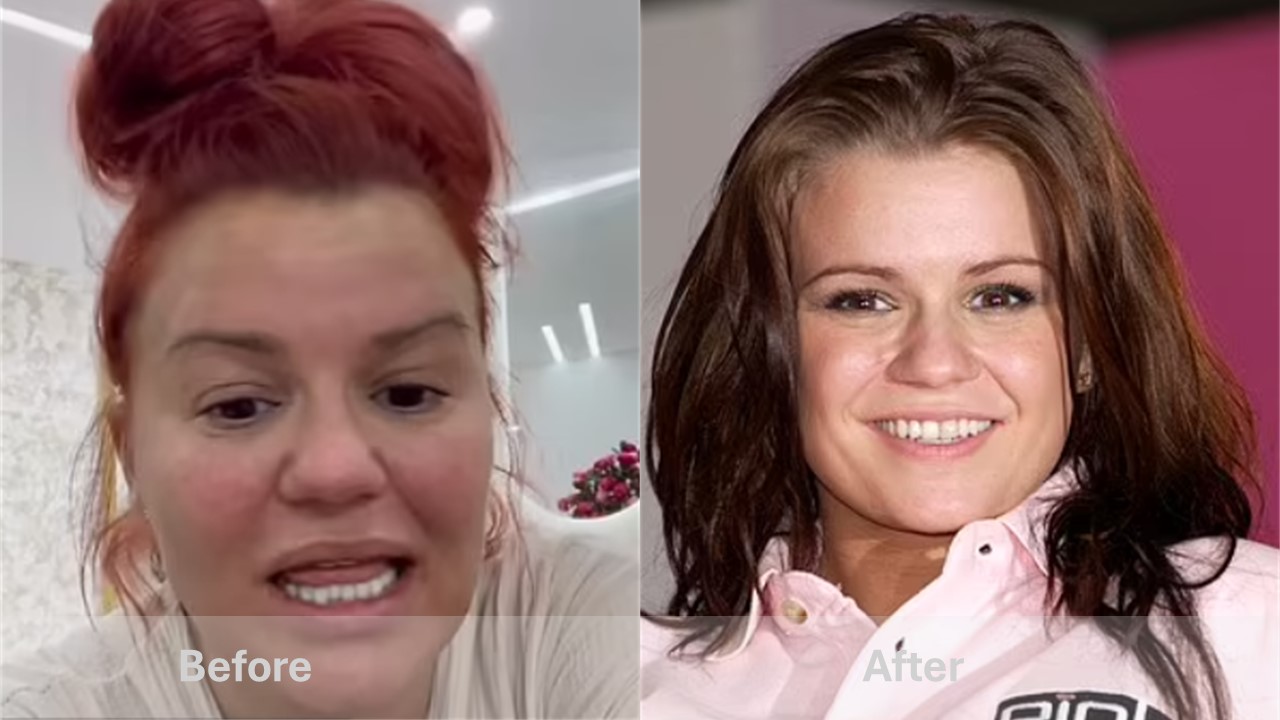 celebrities with teeth implants before and after Kerry Katona