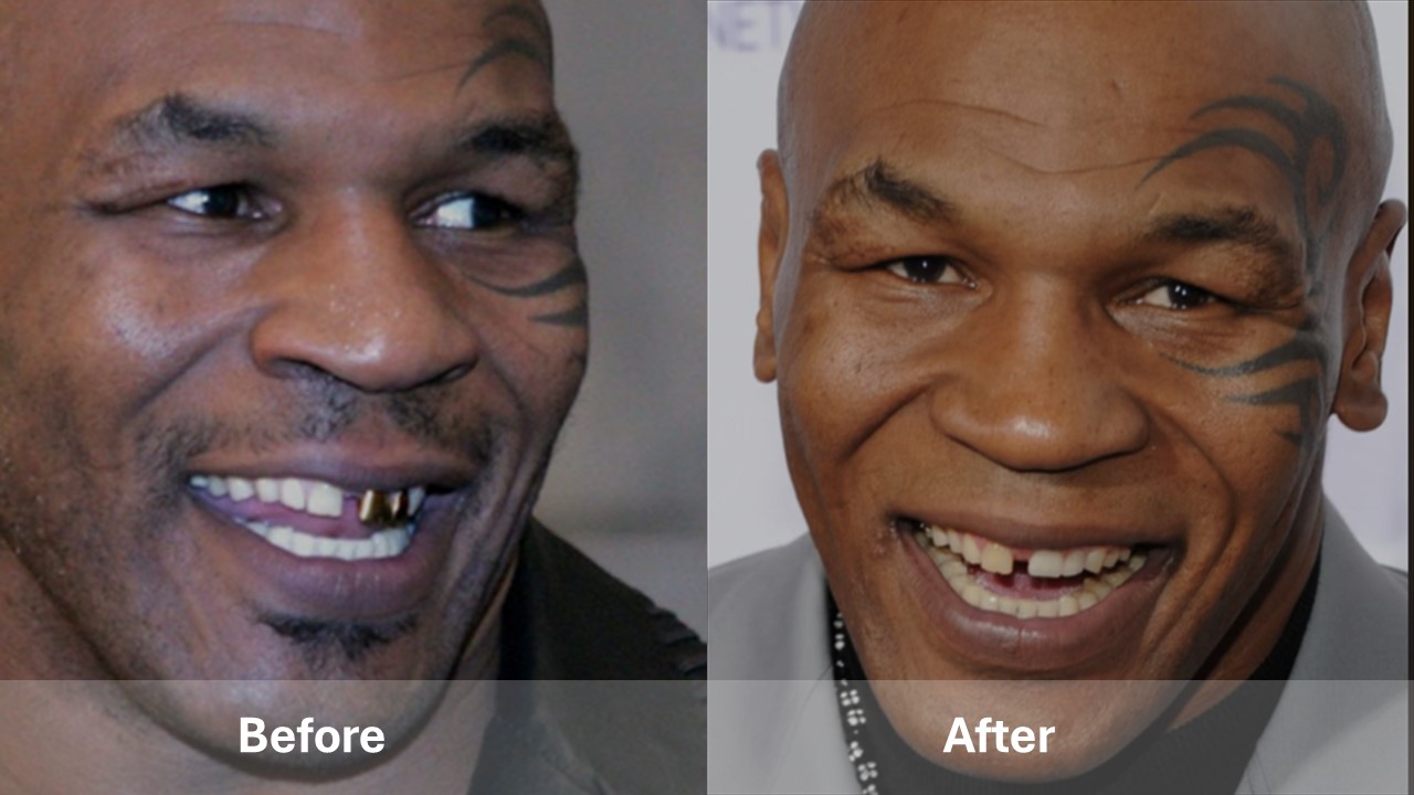 celebrities with teeth implants before and after Mike Tyson