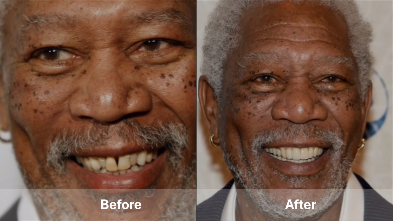 15+ Celebrities with Teeth Implants Before and After