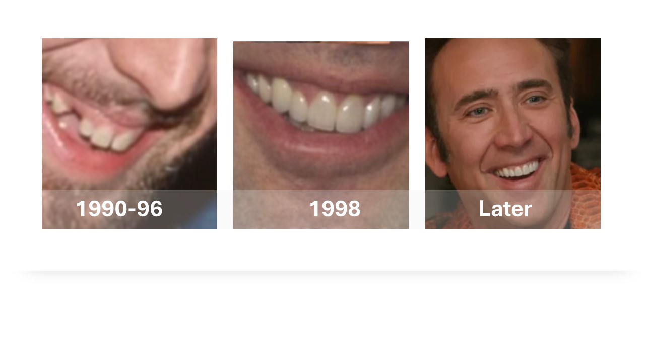 celebrities with teeth implants before and after Nicholas Cage