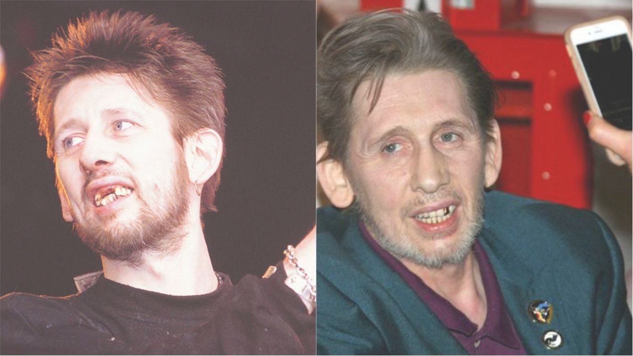 celebrities with teeth implants before and after Shane MacGowan