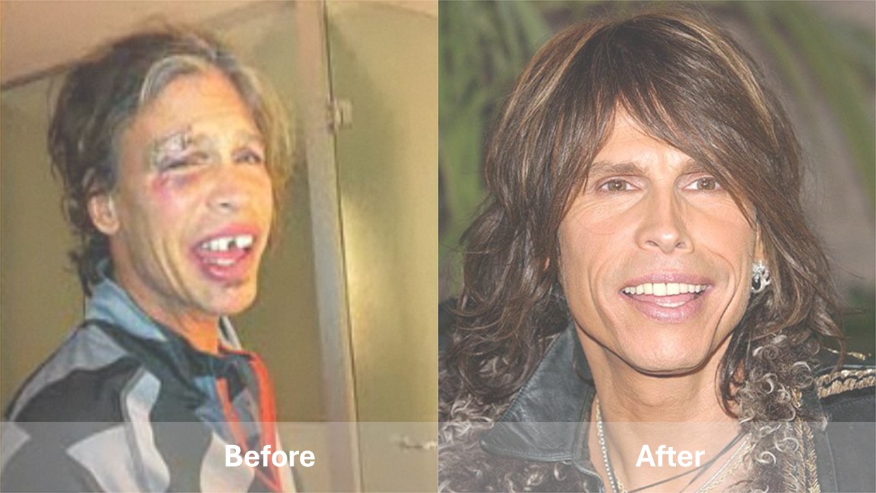 celebrities with teeth implants before and after Steven Tyler