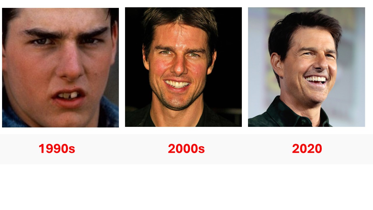 celebrities with teeth implants before and after Tom Cruise