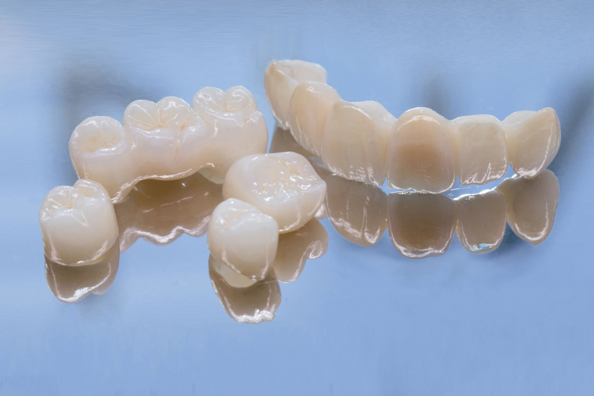 >Indirect Composite Veneers