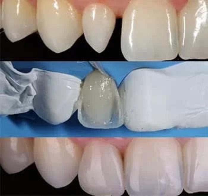 Direct composite-veneers-step-by-step