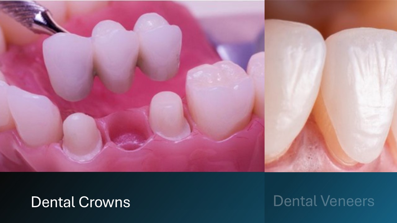 What are dental crowns and dental veneers?