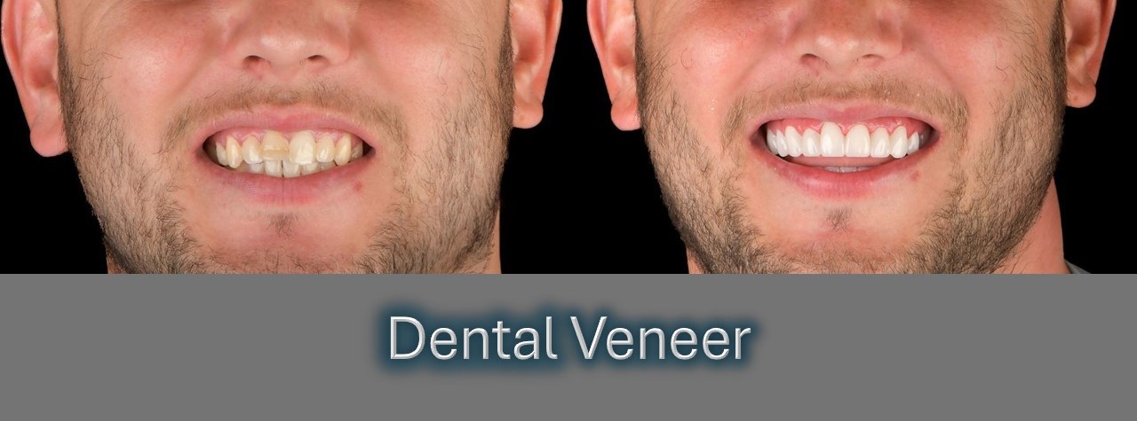 Situations where veneers are preferred