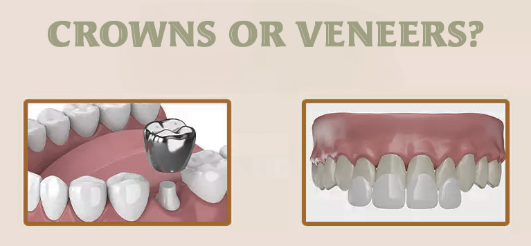 Crowns vs. Veneers