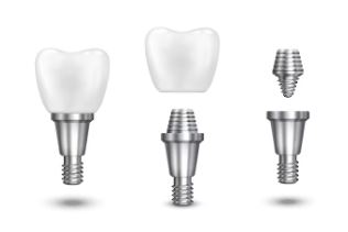 Welche 3 Arten von Zahnimplantaten gibt es?