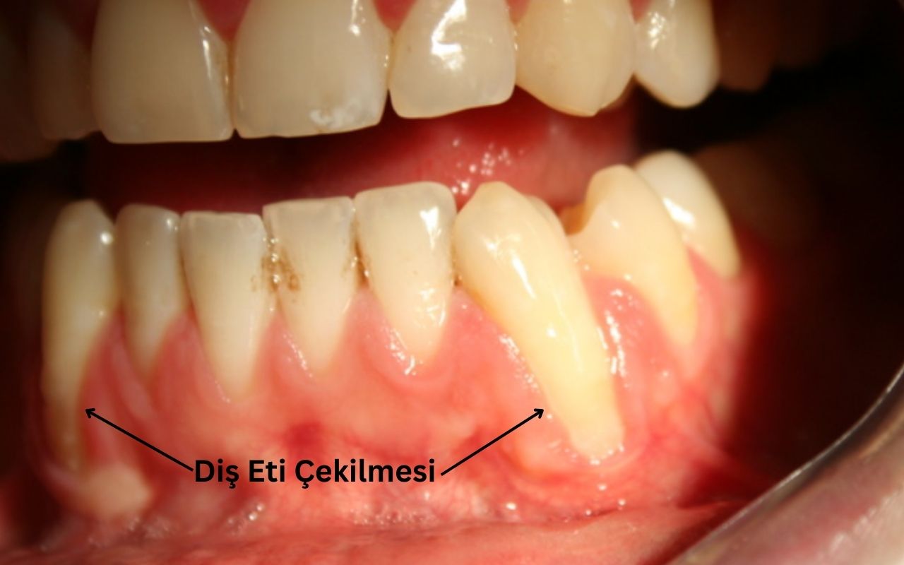 Diş eti çekilmesi nasıl olur?