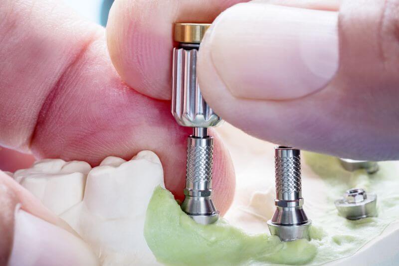 diş implantında nelere dikkat edilmelidir