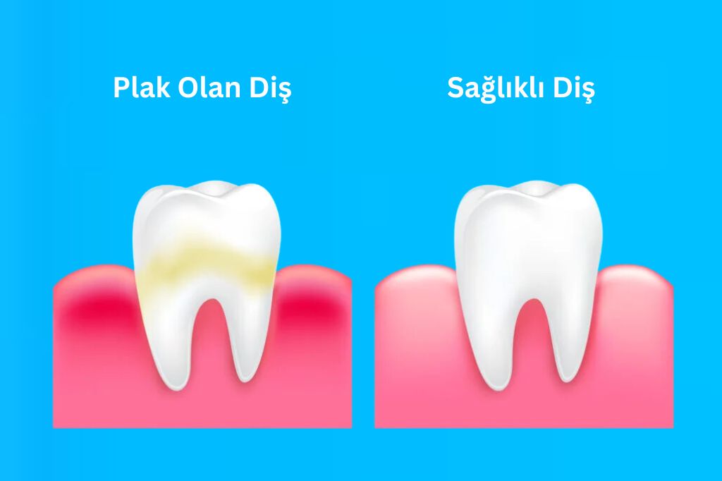 Diş plağı nedir?