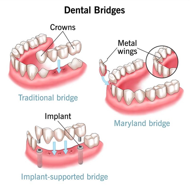 How do implant-supported bridges work?