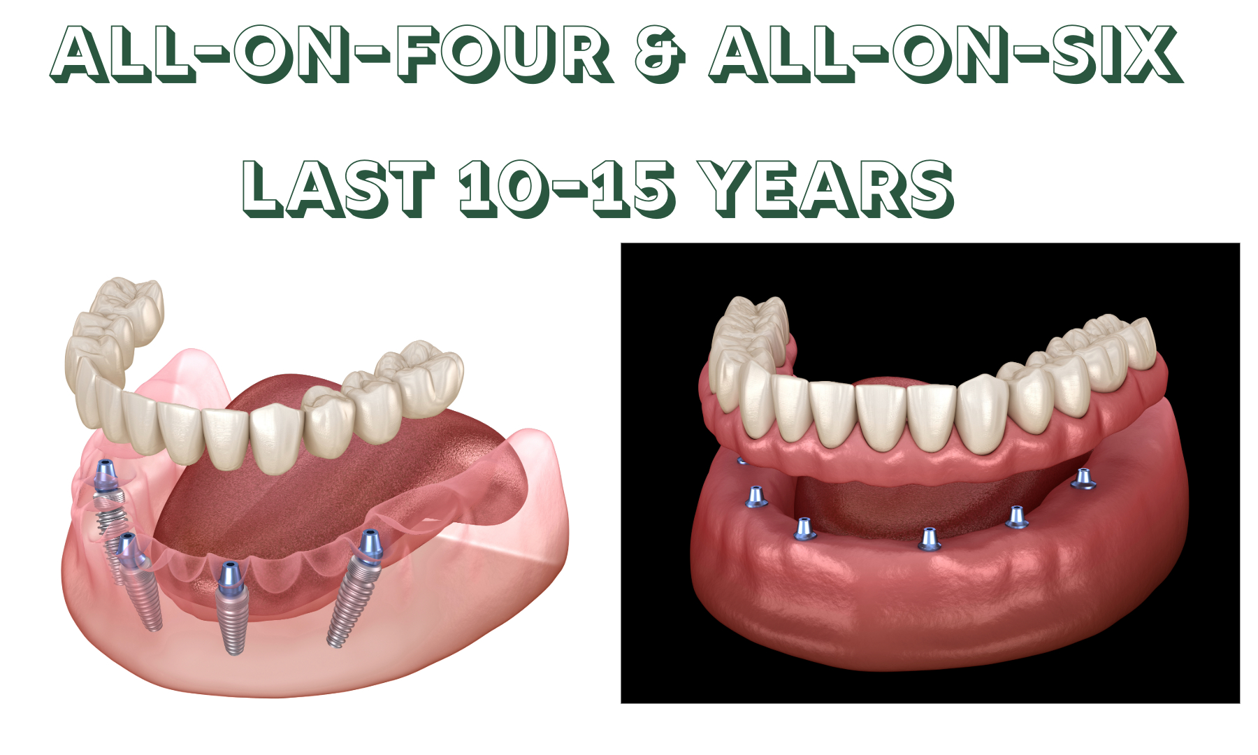 How Long Do All-on-4 & All-on-6 Last?