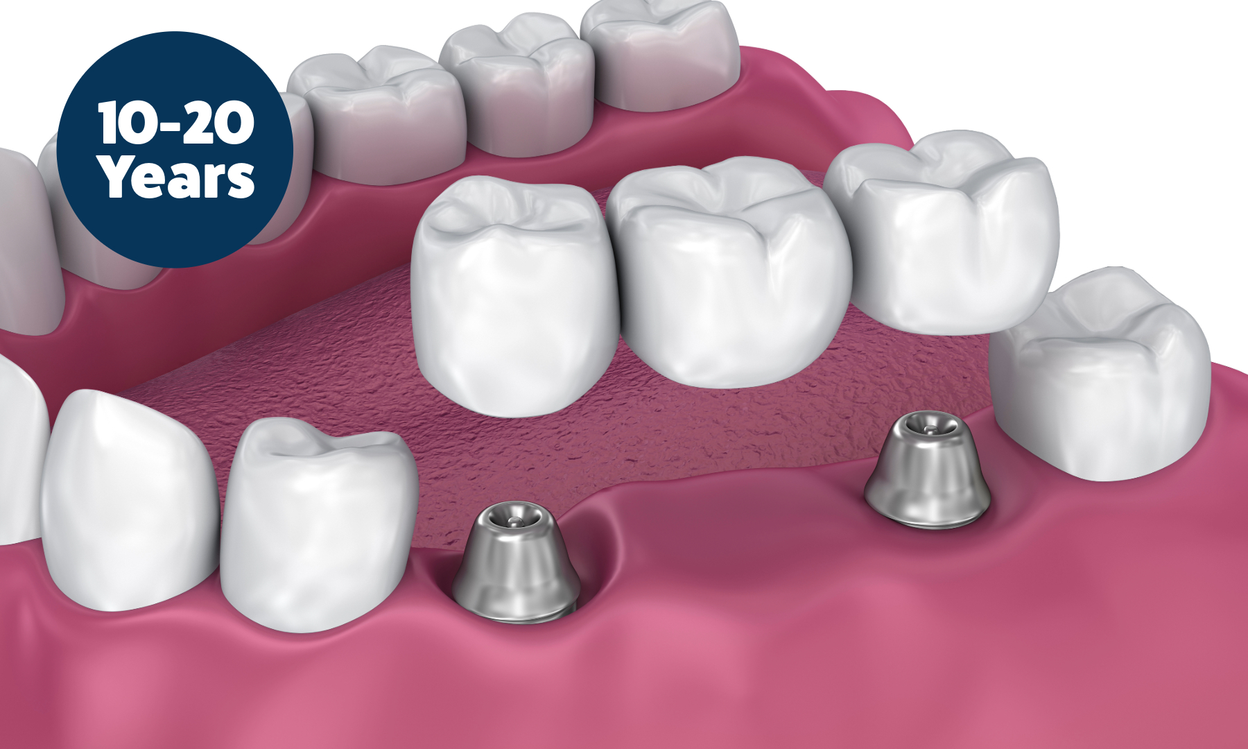 How Long Do Implant Bridges Last?