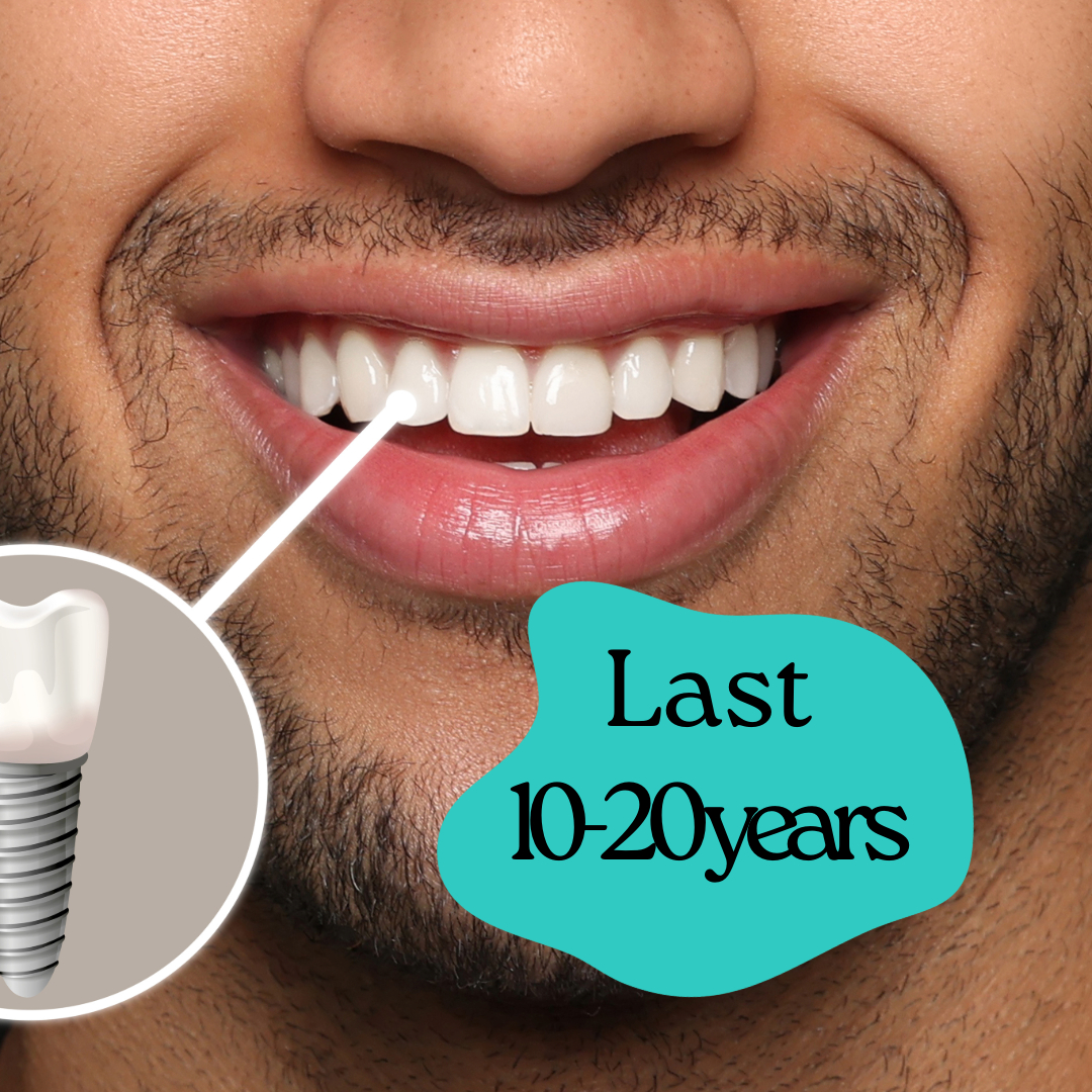 How Long Do Dental Implants Last?