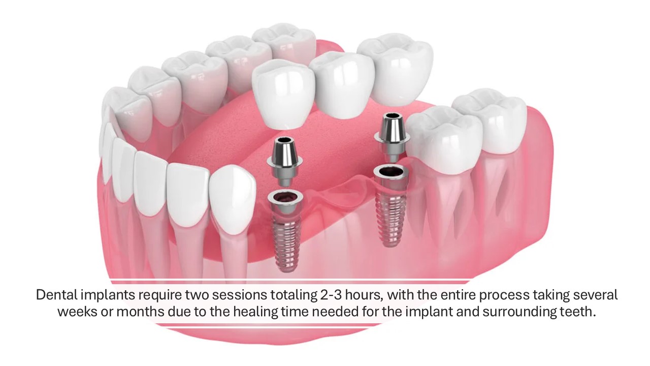 How Long Do Dental Implant Take in Turkey?