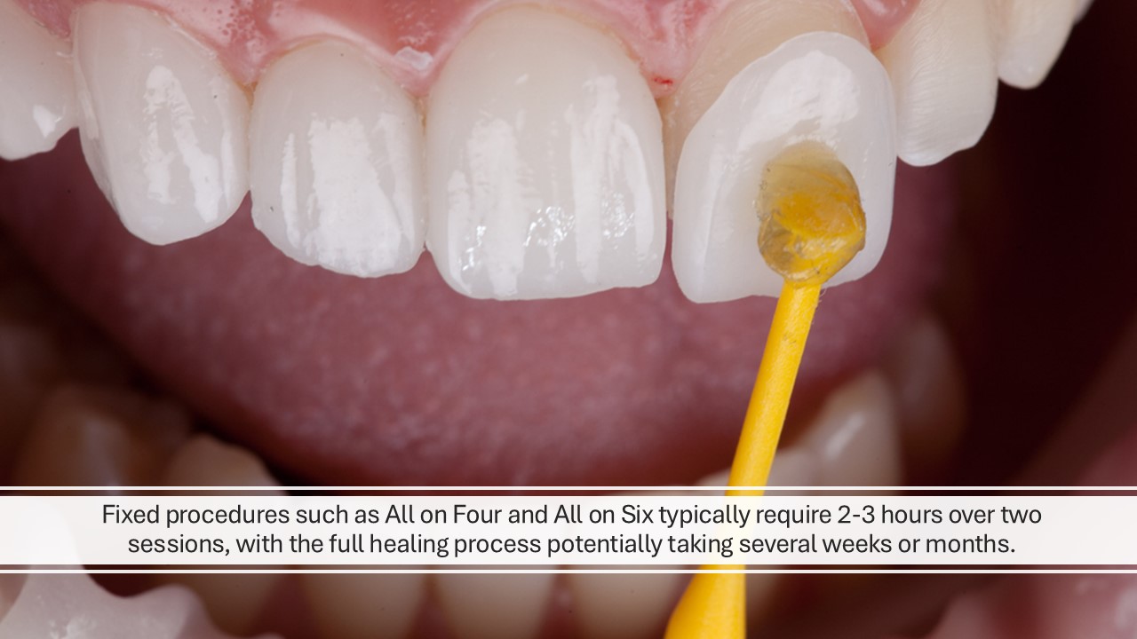 How Long Do Dental Veneers Take in Turkey?