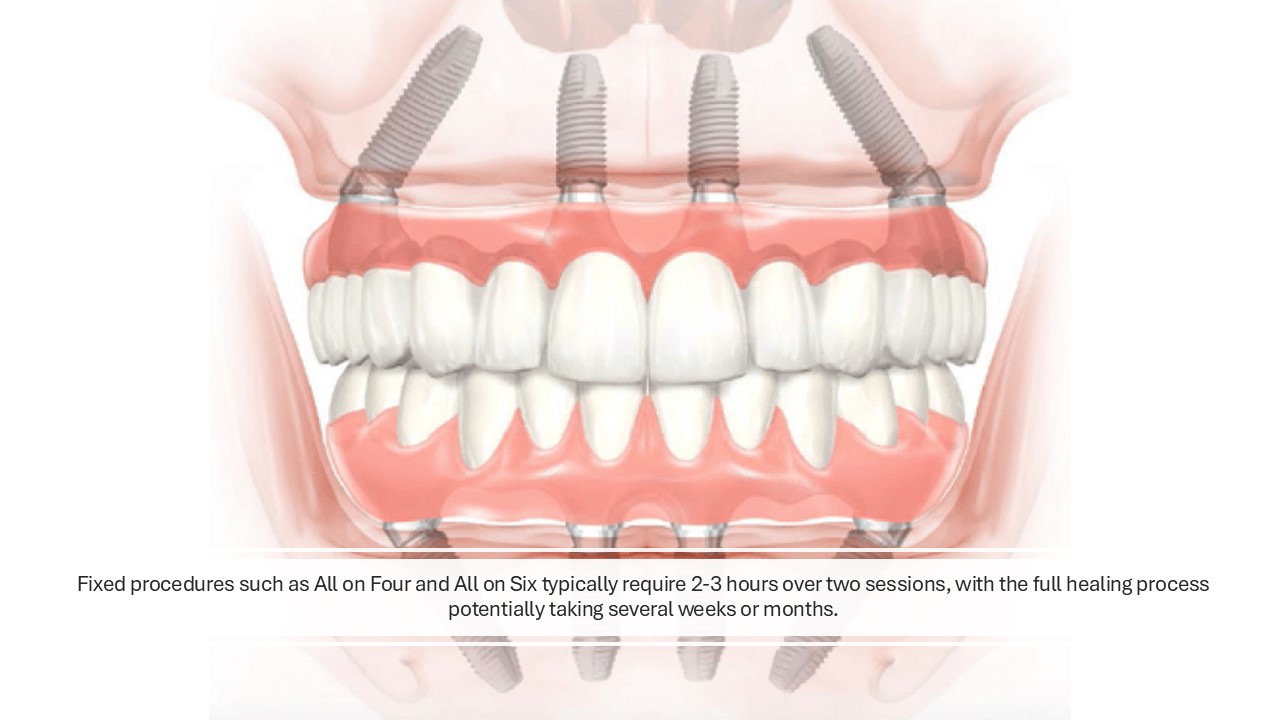 How Long Do All-on-4 and All-on-6 Take in Turkey?