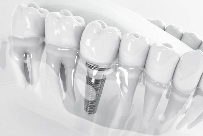 зубные имплантаты на модели челюсти