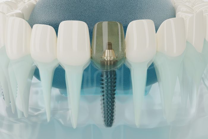 лучшие зубные имплантаты в Турции, Анталья