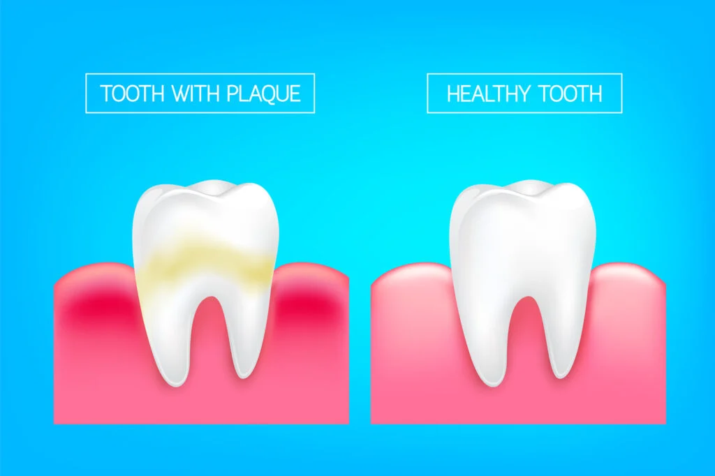 tooth with plaques vs healthy tooth