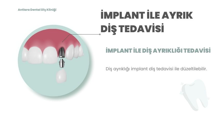 Ayrık diş tedavisinde implant uygulaması Antalya