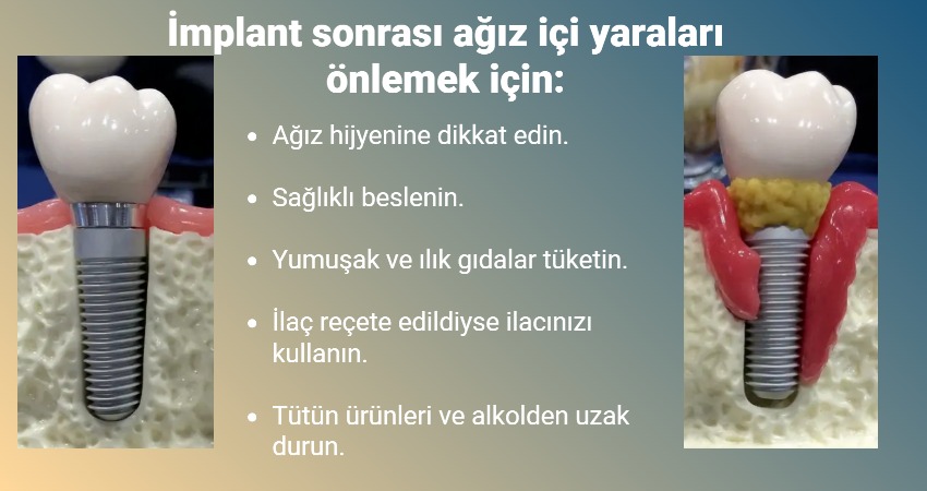 İmplant sonrası ağız içi yaraların çabuk iyileşmesi için ne yapılabilir? Antalya