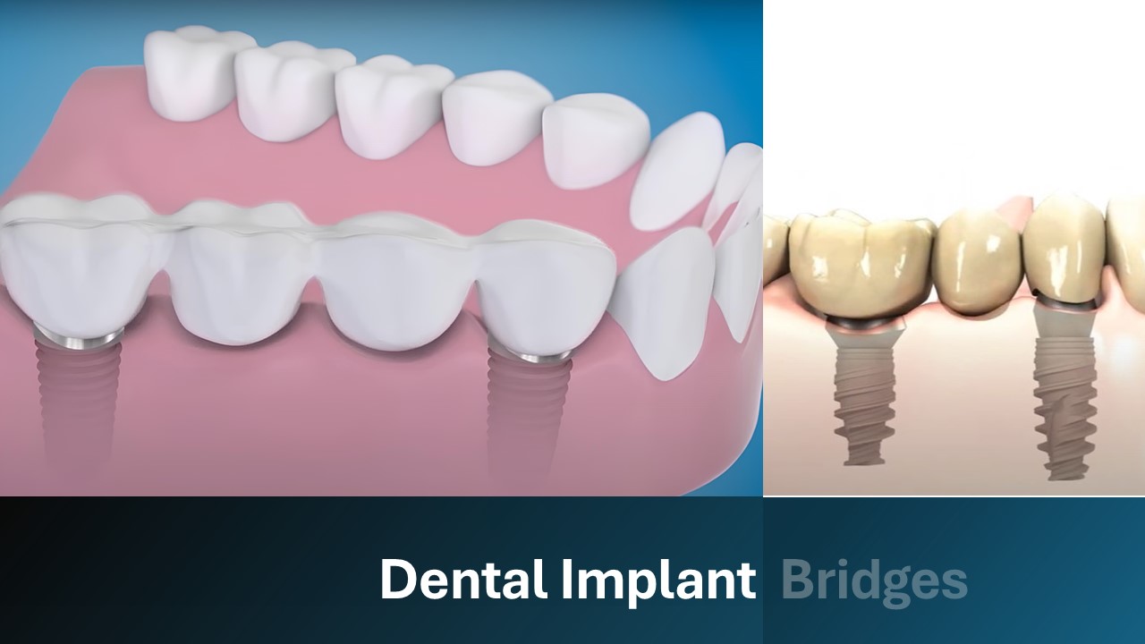 Implant-supported bridges