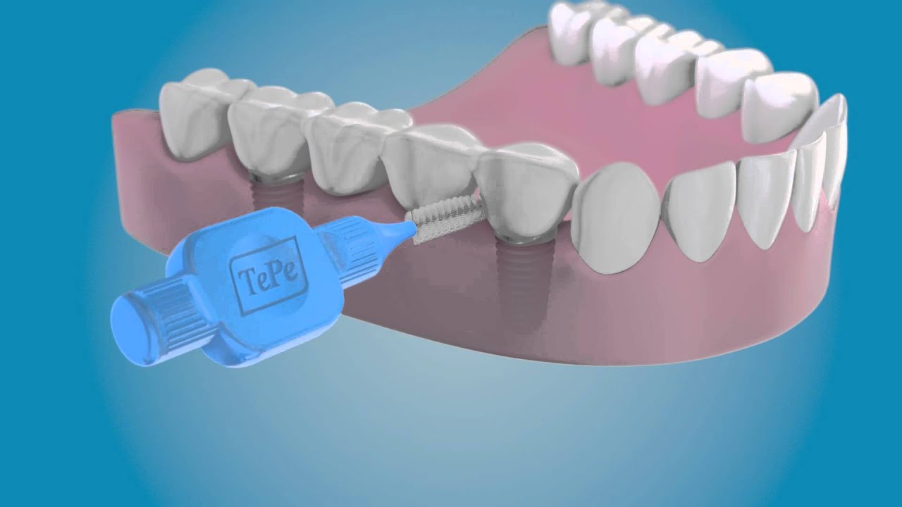 Implant-supported bridges