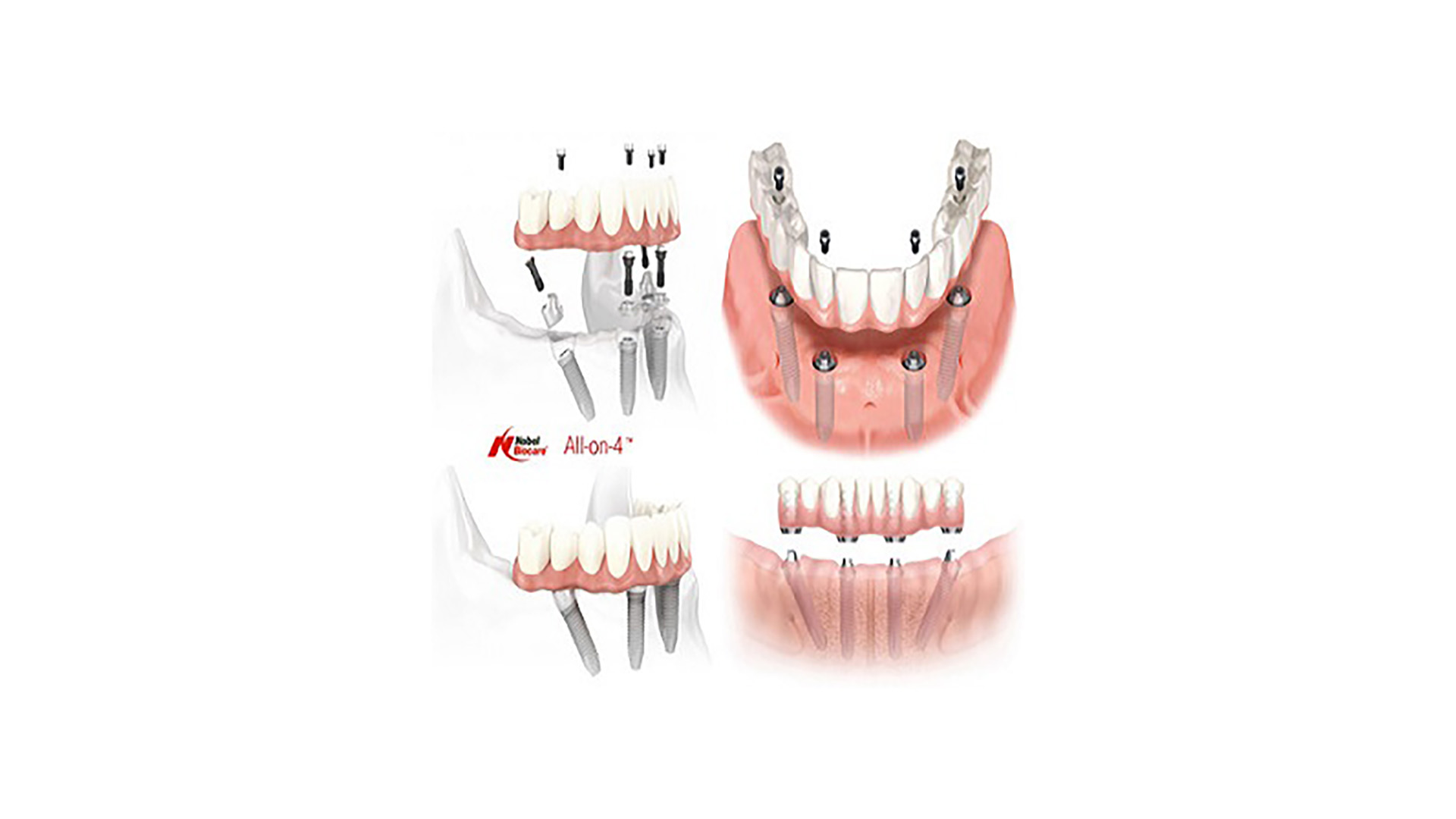 All-on-Four dental implants