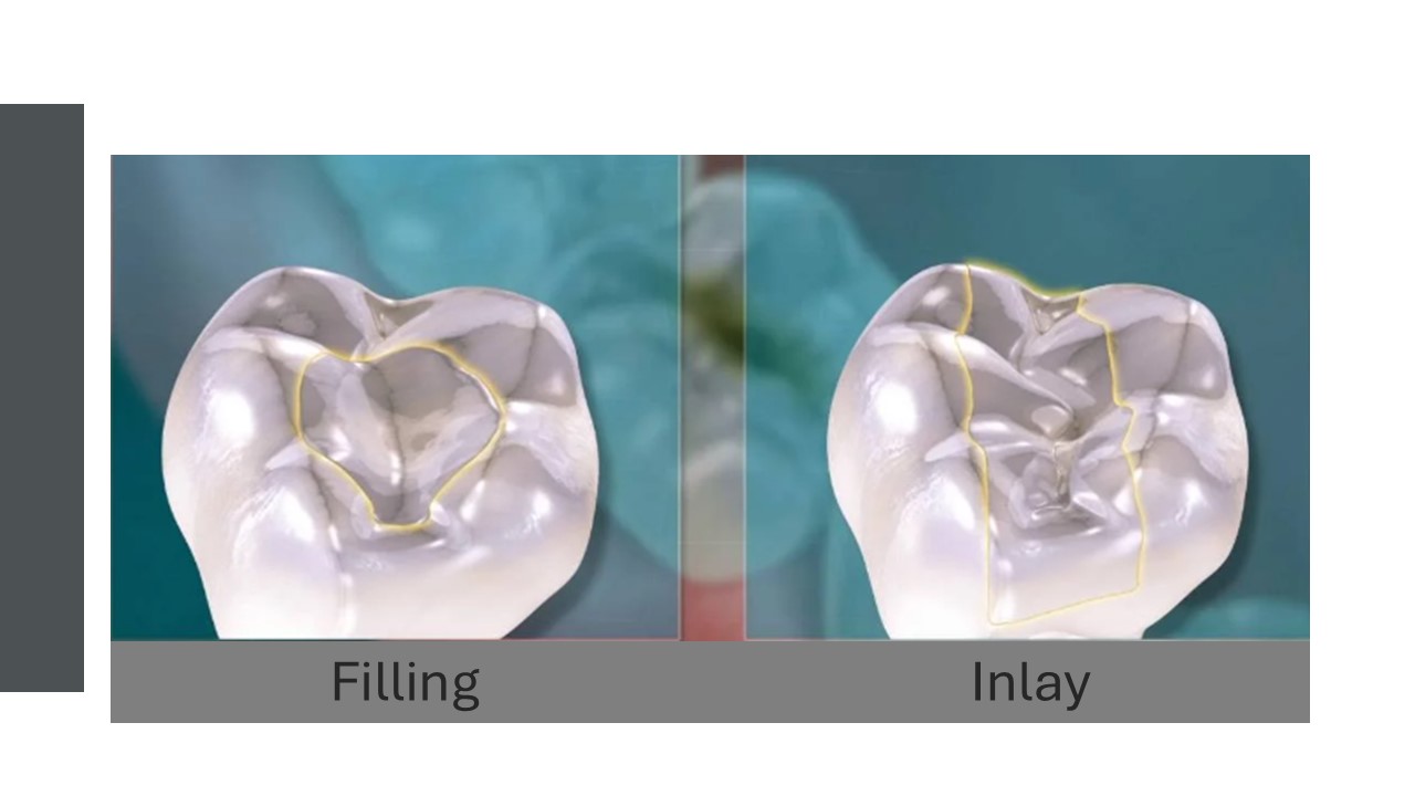 What are the pros and cons of inlays?