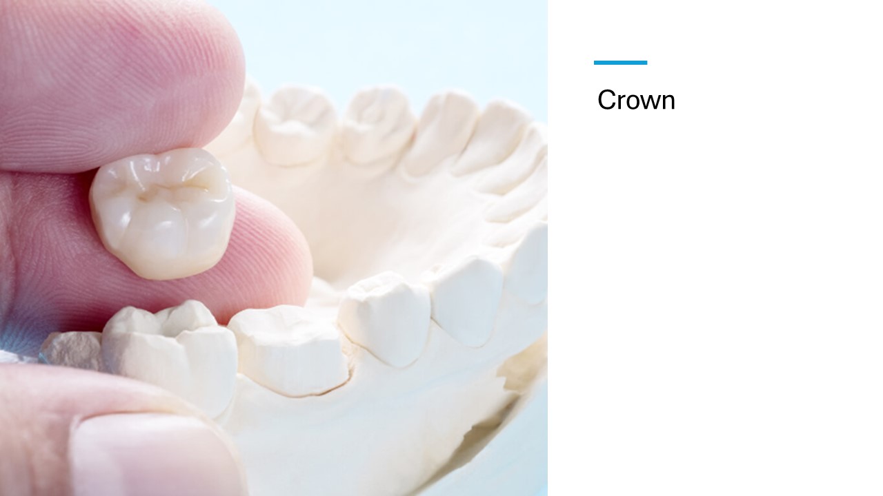 What is a dental crown?